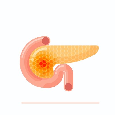 生病的人类胰腺