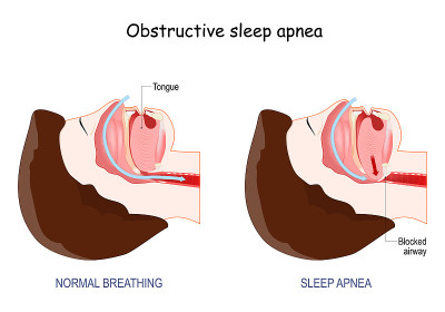 Obstructive Sleep Apnea.