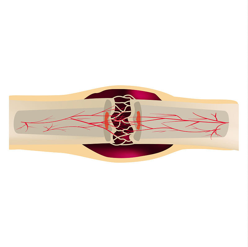 2 Stage Of Healing Bone Fracture. Formation of cal