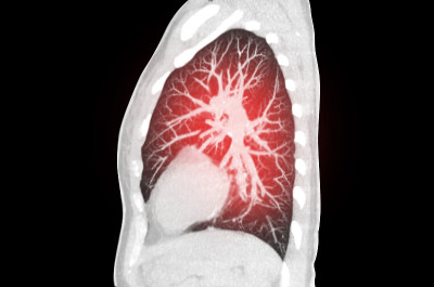 肺部感染covid-19的胸部或肺部矢状面mip CT扫描，伴磨玻璃影。