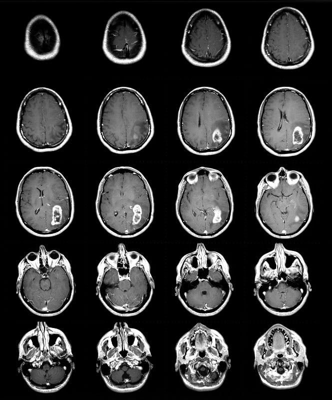脑部Mri显示肿瘤强化