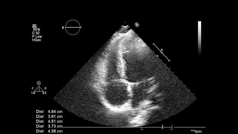 经食管超声检查心脏图像。