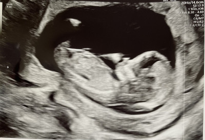 新生的婴儿
