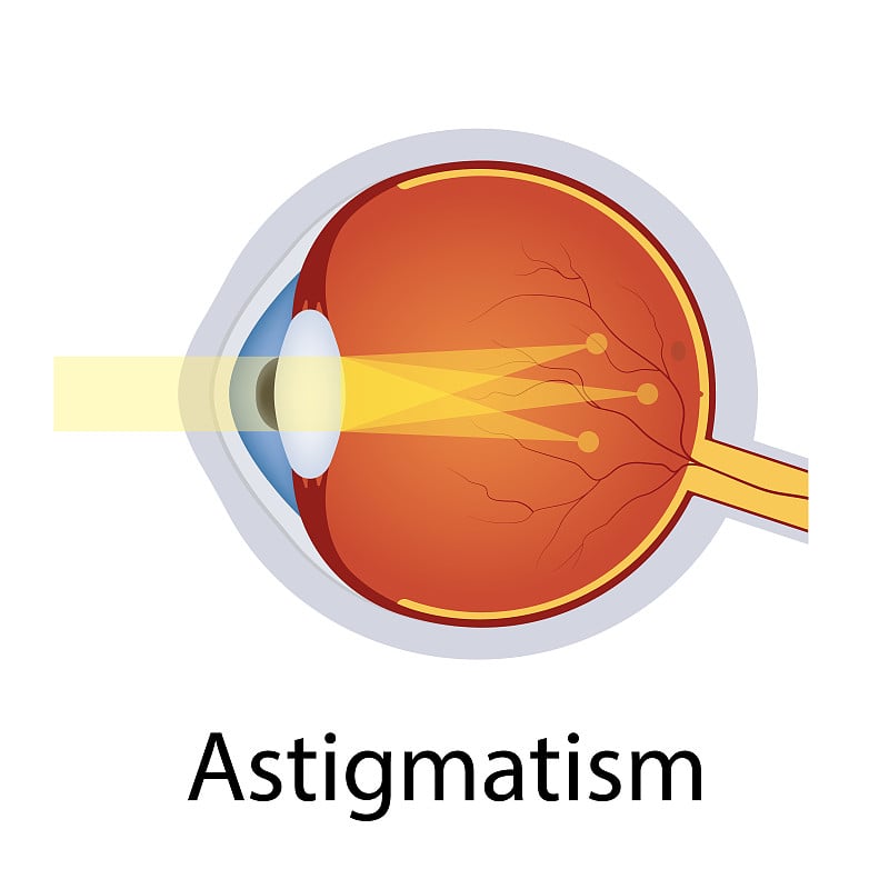 散光和视力障碍插图。眼睛缺陷的概念。详细解剖眼球散光缺损。孤立的向量