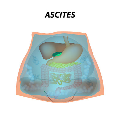Ascites Free fluid in the abdominal cavity. Infogr