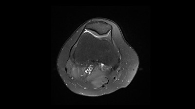 膝关节MRI(磁共振成像)