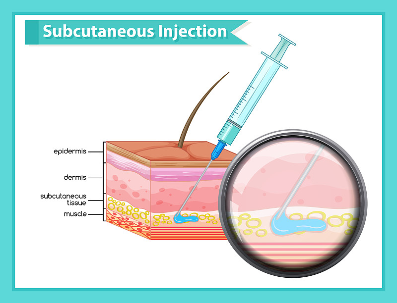 皮下注射的科学医学说明