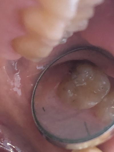 牙科镜显示脏的臼齿
