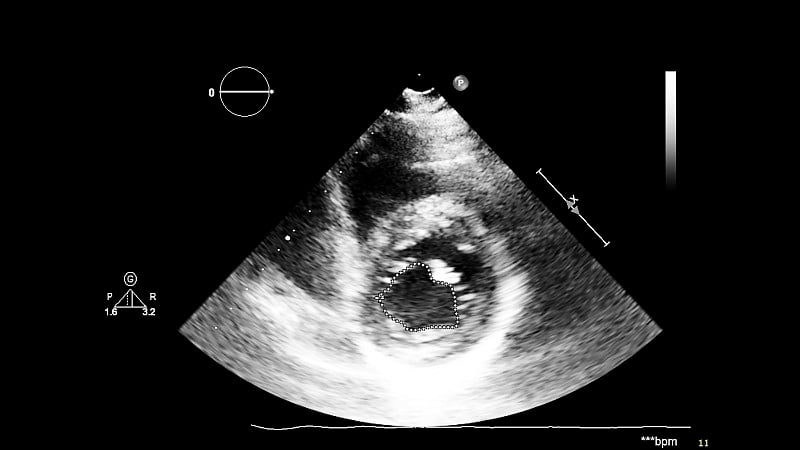经食管超声检查心脏图像。