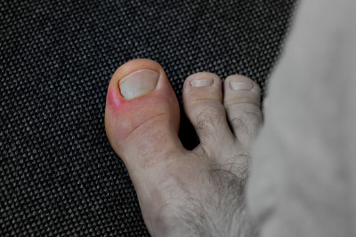 大脚趾的特写和发炎的甲床(甲癣/ panaritium)