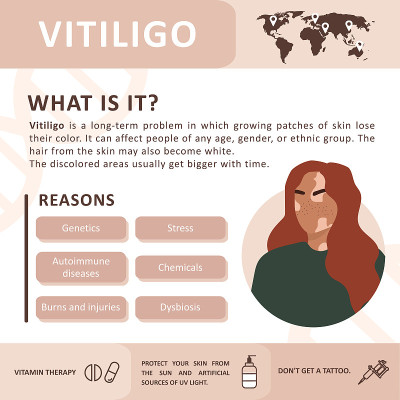 白癜风的图表。致病原因。抽象的女性剪影。Vector概念支持白癜风患者生活和建立对慢性皮肤病的认识。