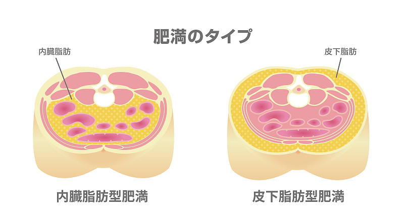 肥胖症的例子。腹部剖视图。(内脏脂肪，皮下脂肪)