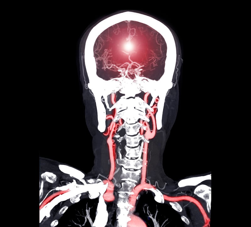 彩色脑CT血管造影或CTA脑冠状面。剪切路径。