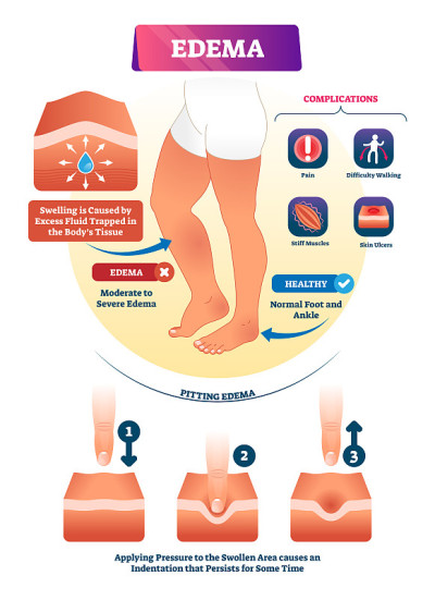 Edema vector illustration. Labeled interstitium fl