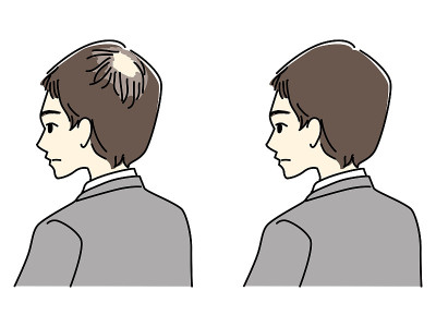前后都是头发稀疏的男人。