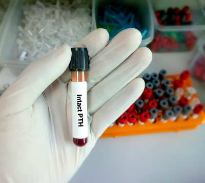科学家或生化学家持有完整的甲状旁腺素(iPTH)测试的血液样本。