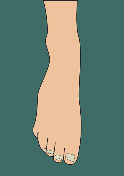 灰指甲