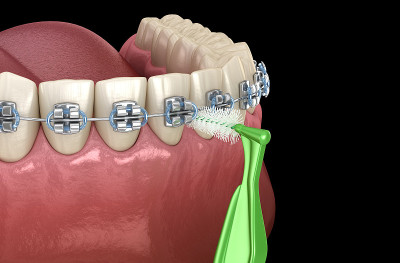 用牙刷和牙套清洁牙齿。口腔卫生的医学精确3D插图。