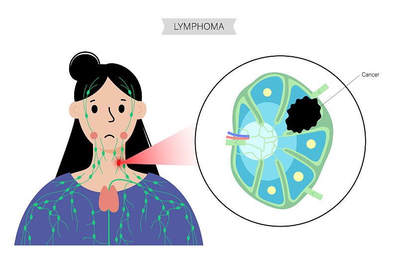 淋巴瘤癌症的概念