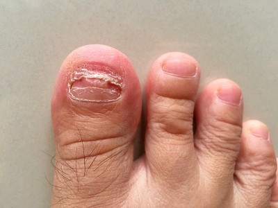 拔下新脚趾甲后缝合