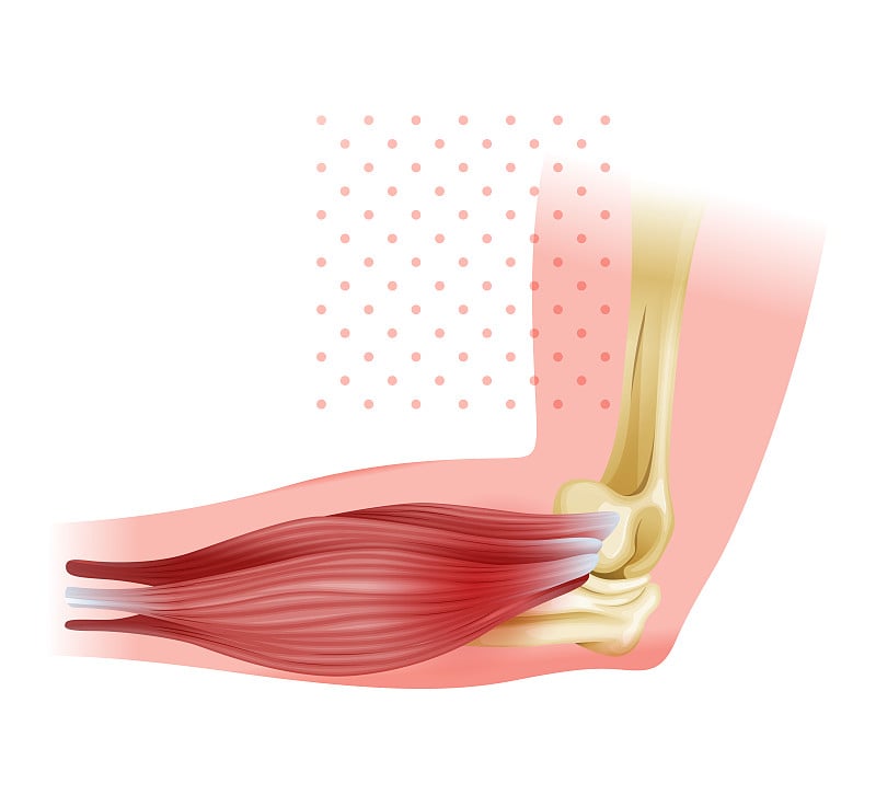 外侧上髁炎称为网球肘-股票插图