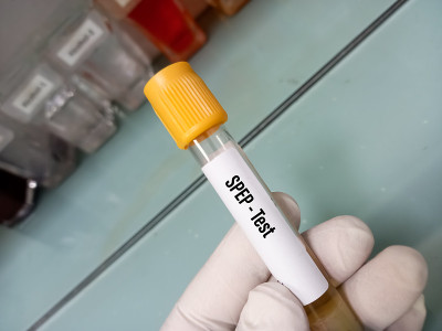 血液样本作血清蛋白电泳(SPEP)试验。医学概念疾病研究
