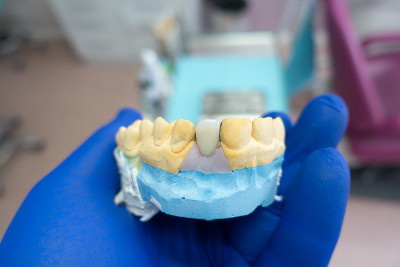 特写陶瓷牙冠在石膏模型的牙齿在牙医的手