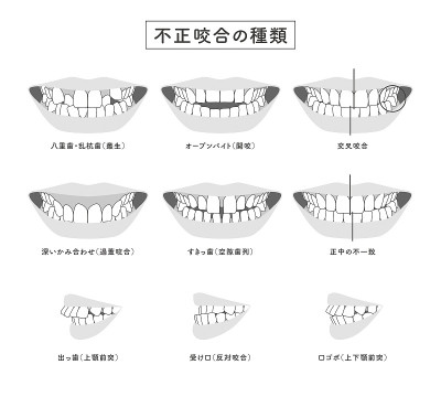 错牙合型插图