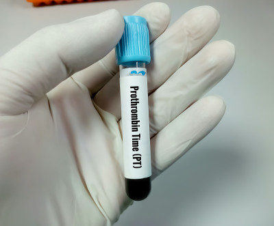 血凝酶原时间(PT)。凝血试验。医学或健康概念。PTT。