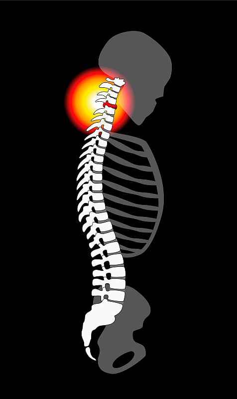 椎间盘突出-颈痛引起的颈椎-纵剖面观。孤立的矢量插图上的黑色背景。