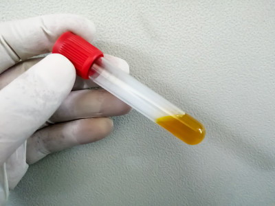 技师戴着手套手持高胆红素血清样本，用于诊断黄疸病。