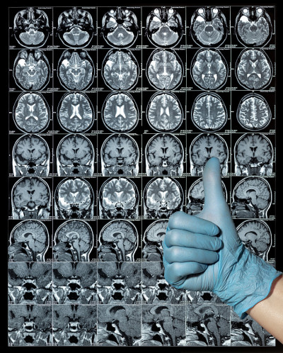 核磁共振脑部扫描或核磁共振成像结果，神经学上的赞同