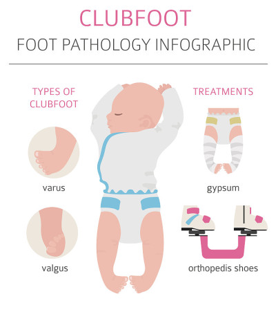 Foot deformation, medical desease infographic. Clu