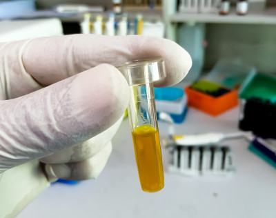 技术人员持有高胆红素血清样本用于诊断黄疸病。