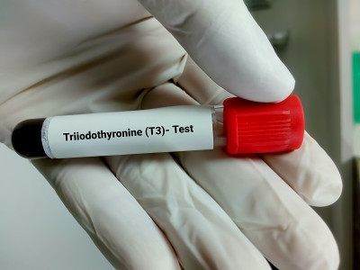 血样三碘甲状腺原氨酸(T3)激素检测。甲状腺机能亢进或减退症的诊断。
