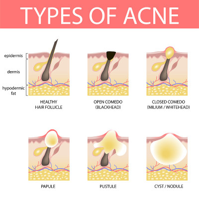 19-01-13-types-of-acne
