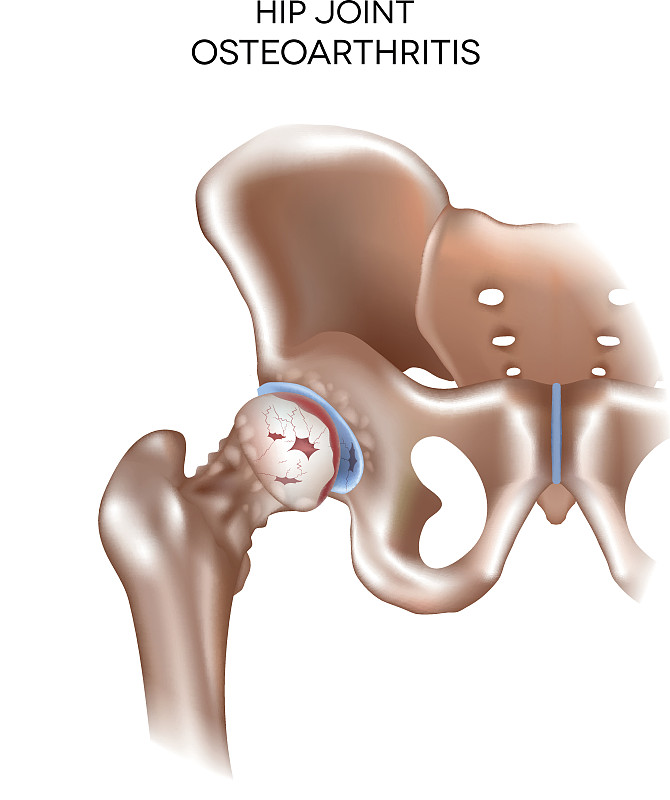 髋关节关节炎髋关节的关节炎