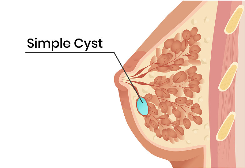 简单的乳腺囊肿解剖说明