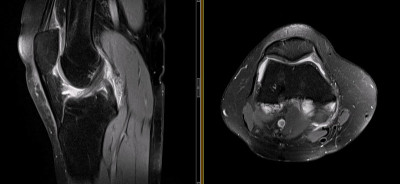 膝关节MRI(磁共振成像)