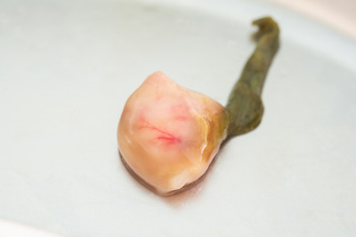 胆囊内的肿瘤