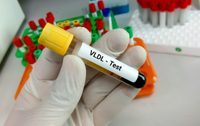 血液样本进行VLDL(极低密度脂蛋白)检测。血脂。坏胆固醇