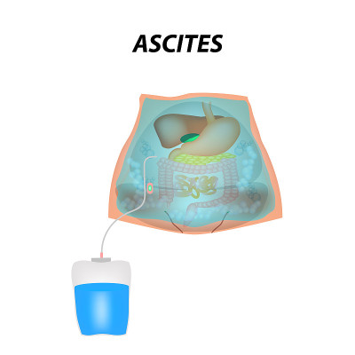 Ascites Free fluid in the abdominal cavity. Infogr