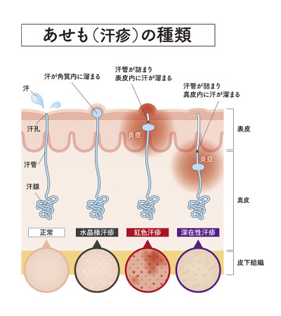 皮肤的横截面29前面