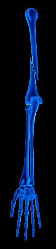 肱骨骨折或骨折手臂完全移位骨折的x光片类型-前视图- 3D医学-生物医学图解-医疗保健-蓝色调
