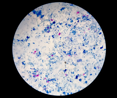 痰涂片AFB染色显微镜近距离观察。Macrobacterium肺结核细菌