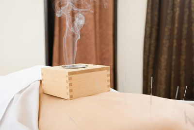 盒灸法放置在女性腰部的一个明亮的针灸中心