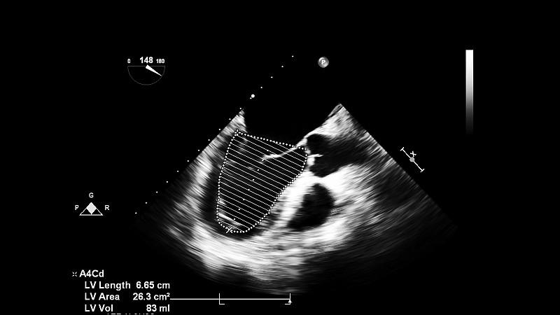 经食管超声检查心脏图像。