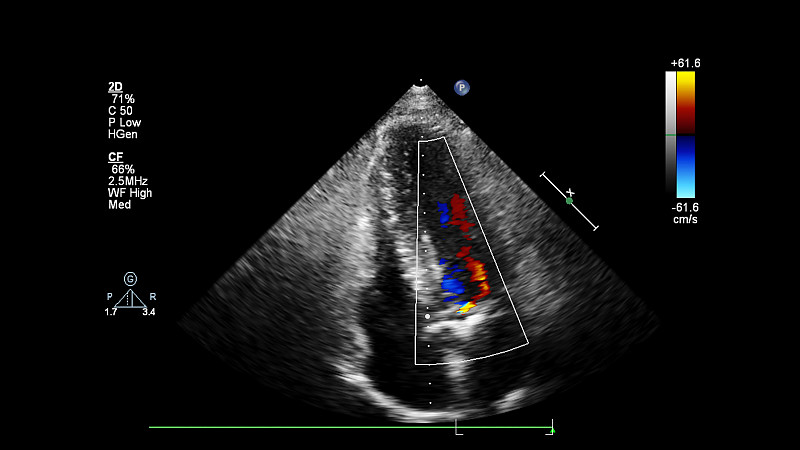 经食管超声检查心脏图像。