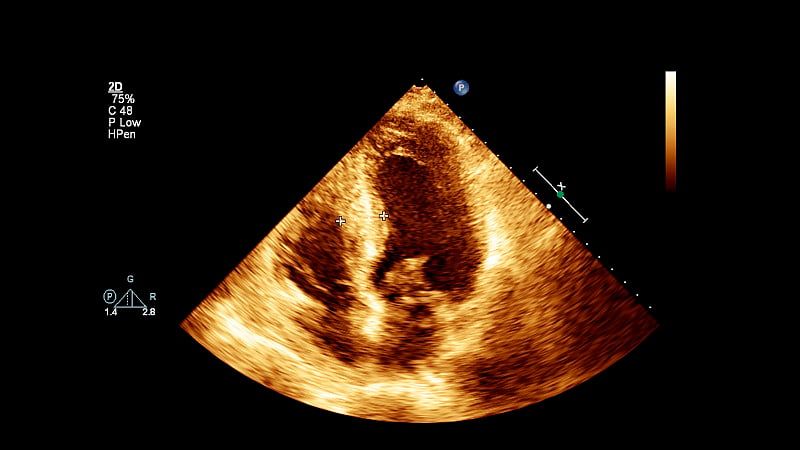 经食管超声检查心脏图像。