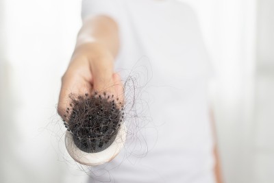女性对洗发水过敏会导致脱发和头皮屑。